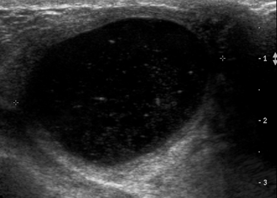 Figure 1 from Breast disorders in pregnant and lactating women.