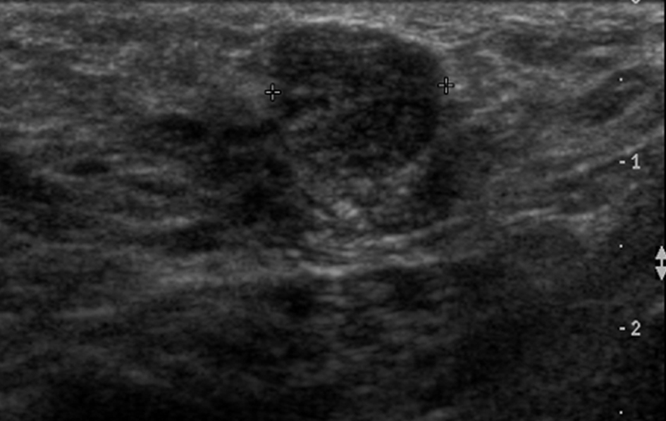 Figure 1 from Breast disorders in pregnant and lactating women.