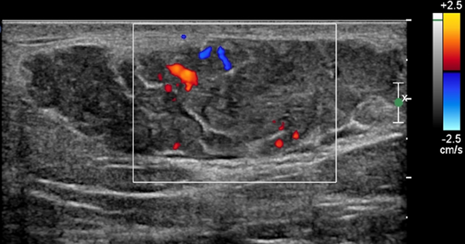 Figure 1 from Breast disorders in pregnant and lactating women.