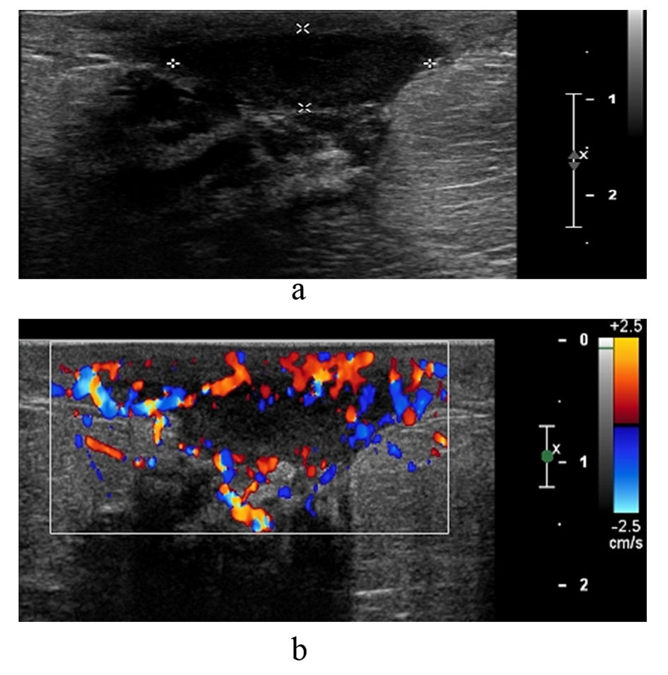 Figure 1 from Breast disorders in pregnant and lactating women