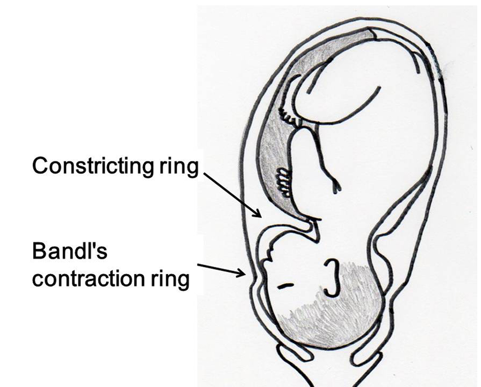 Pre-term uterine constriction rings and their consequences