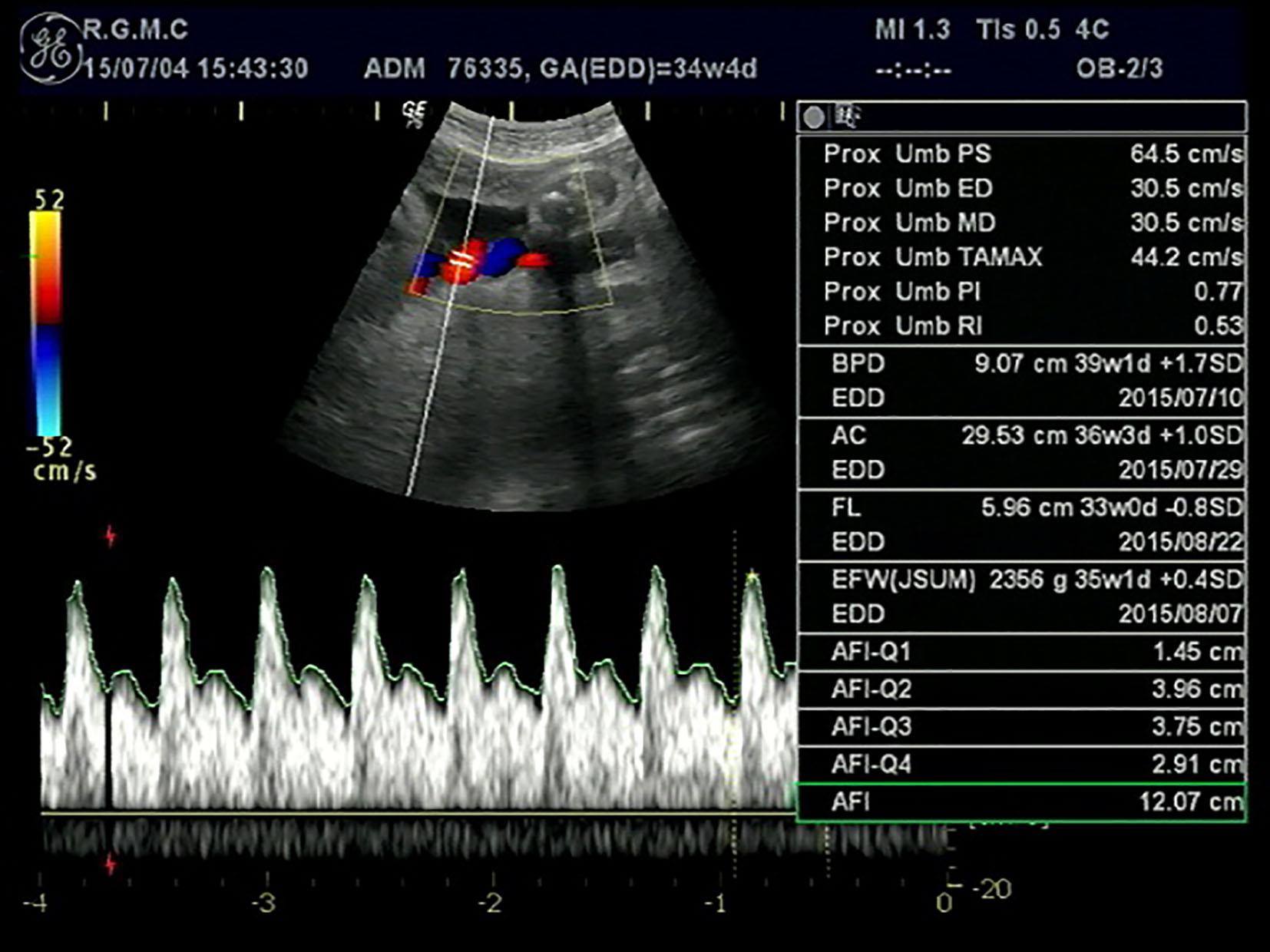 Umbilical Artery Doppler Klopsheet